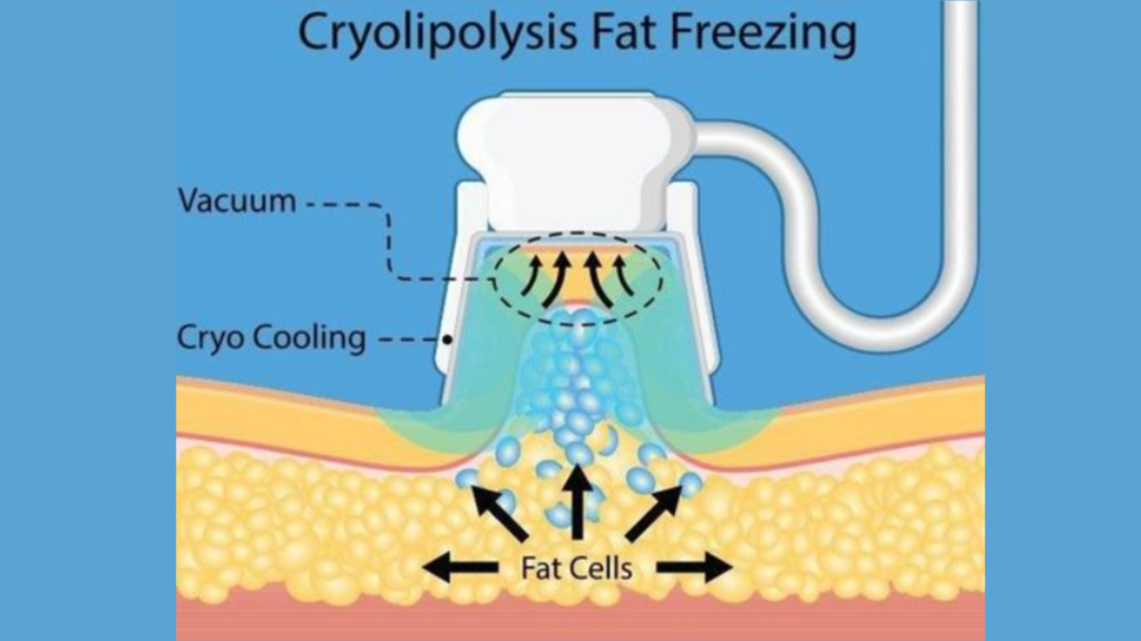 An educational illustration of Cryolipolysis Fat Freezing showing a device applying vacuum and cryo cooling to fat cells beneath the skin, demonstrating the non-invasive fat reduction process.
