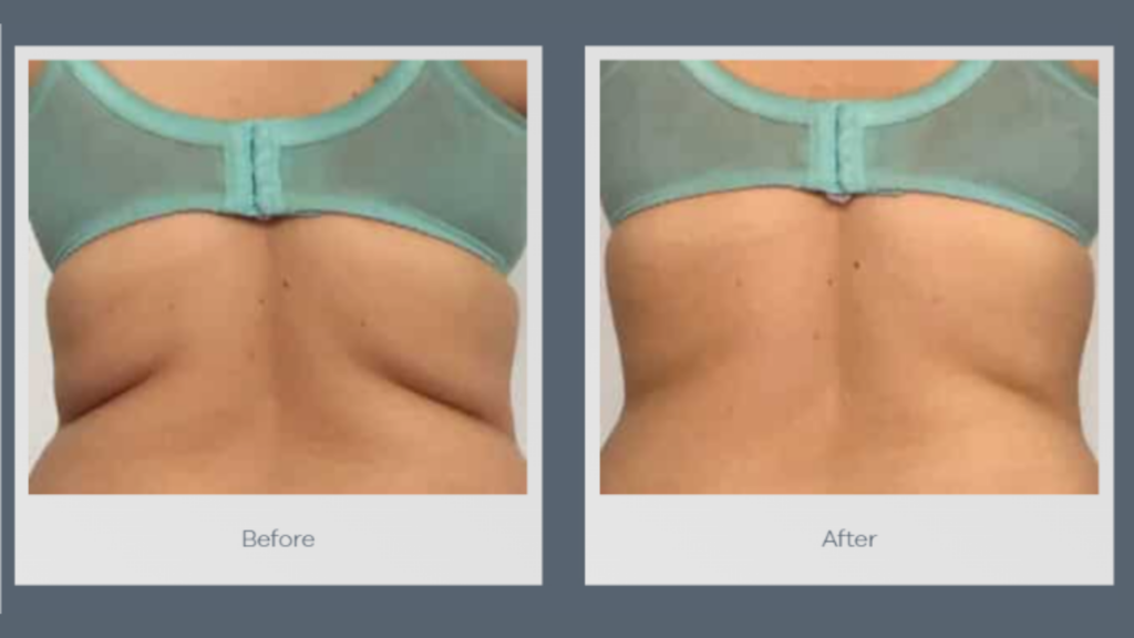 An educational illustration of Cryolipolysis Fat Freezing showing a device applying vacuum and cryo cooling to fat cells beneath the skin, demonstrating the non-invasive fat reduction process.