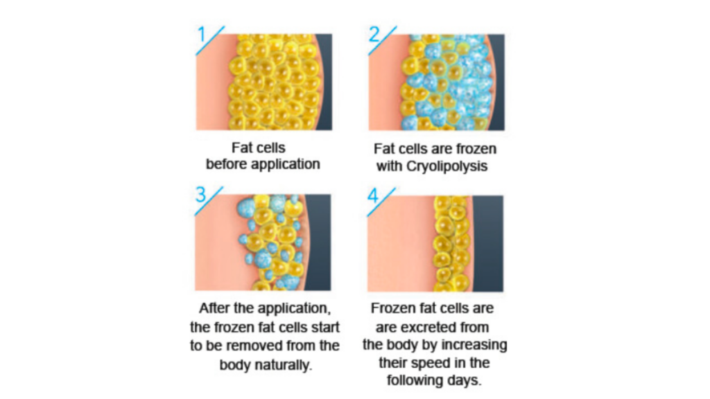 Four-panel diagram showing the fat freezing (cryolipolysis) process. Panel 1: Normal fat cells before treatment. Panel 2: Fat cells being frozen during cryolipolysis. Panel 3: Treated fat cells starting to break down naturally. Panel 4: Frozen fat cells being excreted from the body over time.
