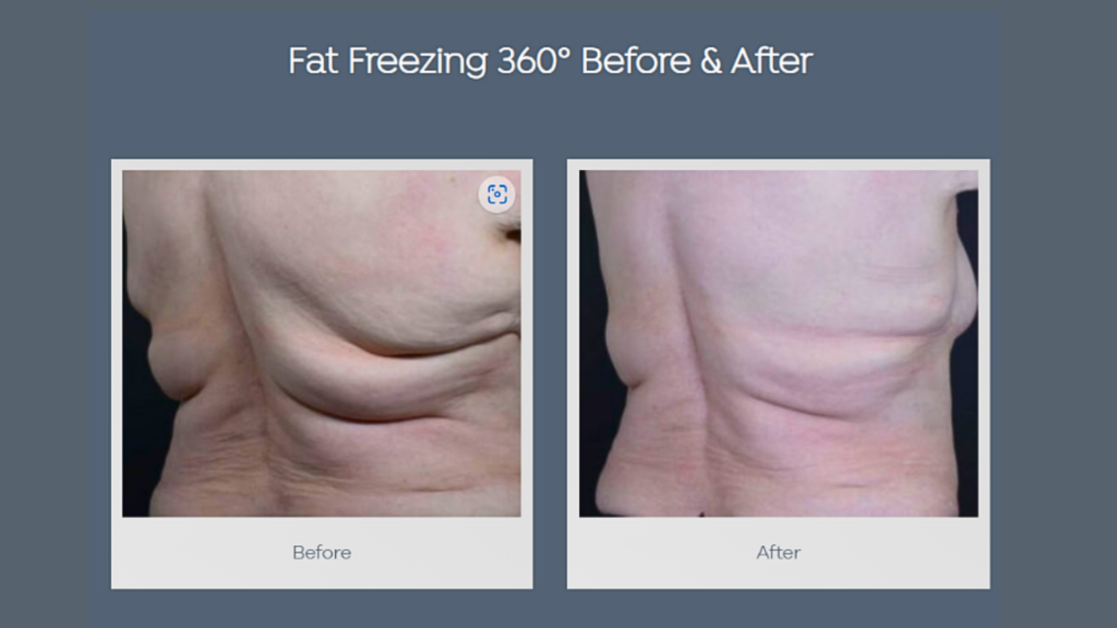 Side-by-side comparison of a patient's midsection showing the visible reduction of fat folds after a 360° fat freezing treatment, with the left image labeled "Before" and the right image labeled "After."
